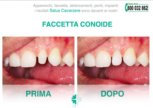 Faccette in ceramica: informazioni e risultati