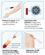 TERAPIA ORTOPEDICA CON PRGF